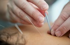 Ear Acupuncture May Ease Chronic Migraine Pain, Early Trial Finds