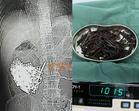 Doktor Keluarkan 1kg Paku Dari Perut Lelaki