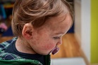 What to know about measles symptoms as adult dies from virus