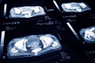 The new prostate cancer test that could predict disease 15 years in advance