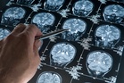 Microdosing LSD can improve your brain function – if you’re a woman