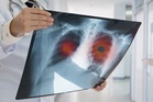 Newly developed drug helps extend the lives of lung cancer patients in trial