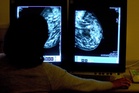Young women who are overweight may be less likely to develop breast cancer