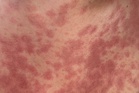 Meningitis B: The symptoms to know as fourth case confirmed in Reading
