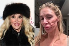 Real Housewives star says she’s having ‘face taken off’ to treat mystery skin condition