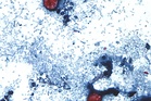 Cyclosporiasis outbreak: Symptoms to watch for as ‘explosive diarrhea’ cases climb in US