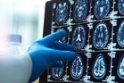 Scientists reveal protein that could reverse damage from Alzheimer’s disease