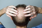 Weight loss drugs linked to loss of hair in major new study