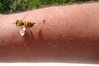 Woman turns to bee venom therapy to treat Lyme disease symptoms
