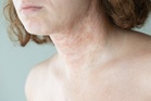 Common eczema treatment may provide little benefit, study finds
