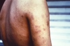 Leprosy cases are on the rise in Florida. Here’s how to reduce your risk