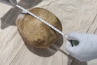 Surgeons in Sri Lanka remove man’s ostrich egg-sized bladder stone