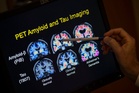 Want to lower your risk of dementia? It doesn't involve a blood test