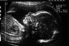 Doctors shrink tumour of baby still in womb in major breakthrough