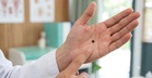 New Mole on Your Palm? Here’s Why a Viral Post Has Everyone Talking
