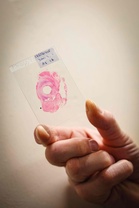 Doctors report breakthrough as cancer jab reportedly eradicates tumours in international trial across 11 countries