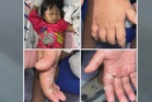 Budak perempuan melecur jari telunjuk kena renjatan elektrik pengering rambut