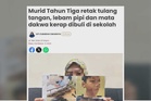 JPN Kedah siasat kes buli sampai retak tulang tangan, lebam pipi, mata