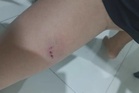 Pelajar Tingkatan 1 cedera kaki kiri digigit anjing liar