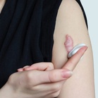 Parut keloid boleh membesar, sebabkan kesakitan dan kegatalan