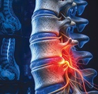 Sciatica: Saraf tertekan punca sakit belakang, punggung dan kaki