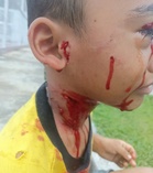 Kanak-kanak tujuh tahun cedera diserang sekumpulan anjing liar
