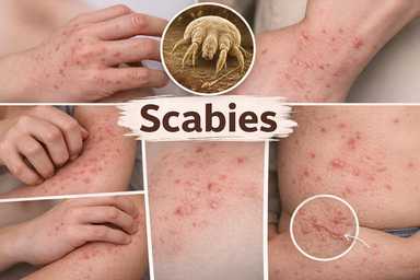 一到晚上就痒到睡不着？小心是疥疮