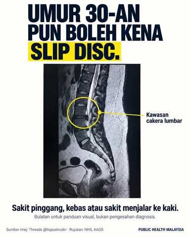 Slip disc umur 30-an?