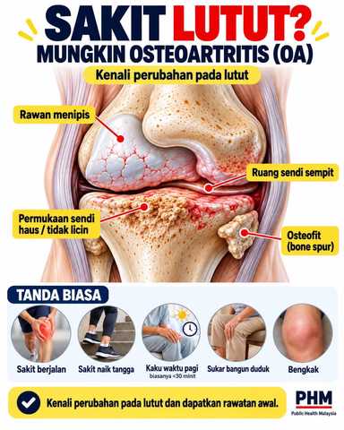 Sakit lutut? Mungkin osteoartritis