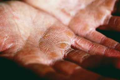 Health Matters: Skin Problems — When Your Skin Is Trying to Tell You Something