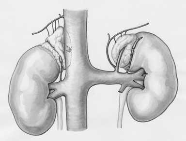 I Watched My Grandfather Fight CKD — Chronic Kidney Disease Life