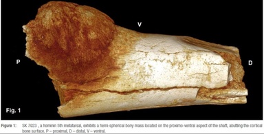 Who Was the First Human to Develop Cancer?
