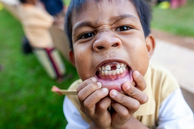 This Mysterious, Little-known Tooth Condition Affecting Millions of Children