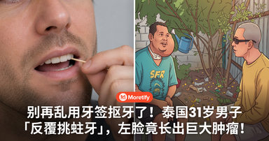 别再乱用牙签抠牙了!泰国31岁男子「反覆挑蛀牙」,左脸竟长出巨大肿瘤!