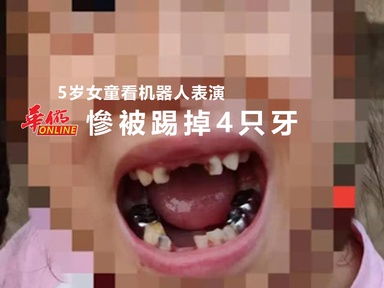 5岁女童看机器人表演 慘被踢掉4只牙