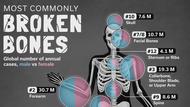 Ranked: The 10 Most Commonly Broken Bones