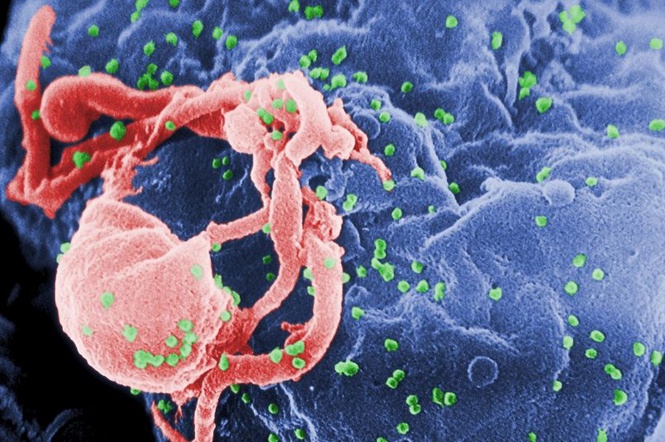 Pesakit HIV Disahkan Sembuh Menggunakan Sel Tunjang
