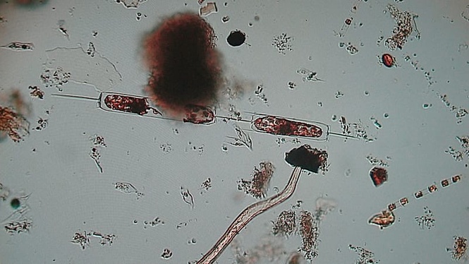 Latest 'flesh-eating bacteria' outbreaks worldwide