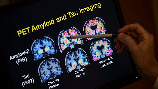 New molecule restores memory in animals with Alzheimer's' disease
