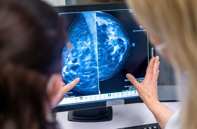 Image from: Breast cancer study: Lymph nodes changes could reveal who is at risk