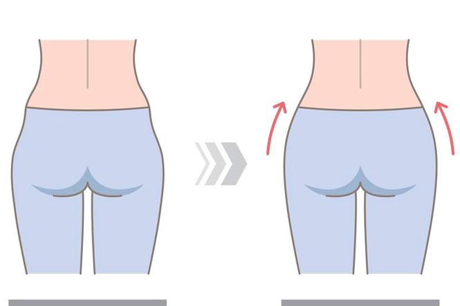 Image from: Hip dips: what are they and can you really get rid of them?