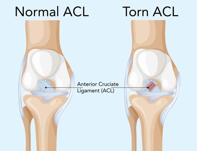 Image from: DoctorSpeak : All about knee injuries