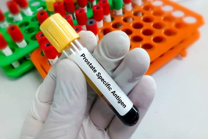 Image from: Prostate cancer overdiagnosis risk sharply rises after age 70 – new research