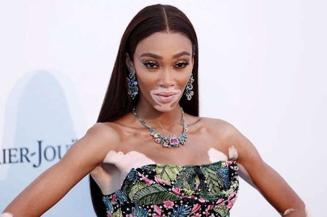 Image from: Vitiligo affects around 1 in 100 people worldwide – yet the skin condition remains misunderstood