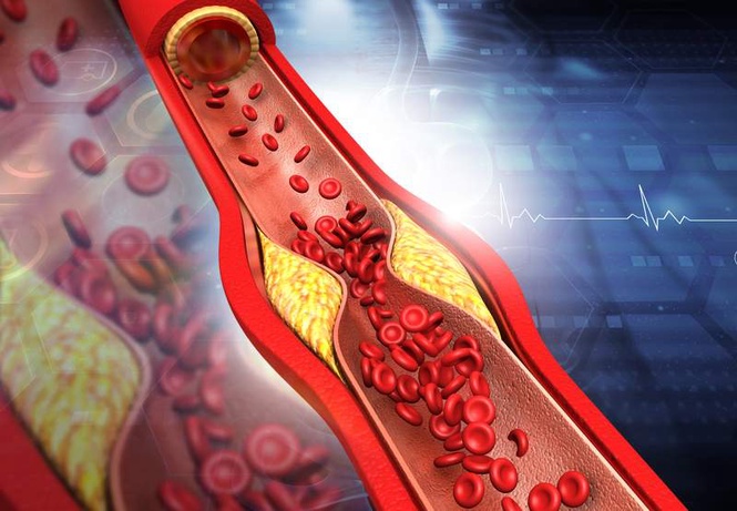 Image from: One-time gene therapy may lower up to 62% ‘bad’ cholesterol, clinical trial results show