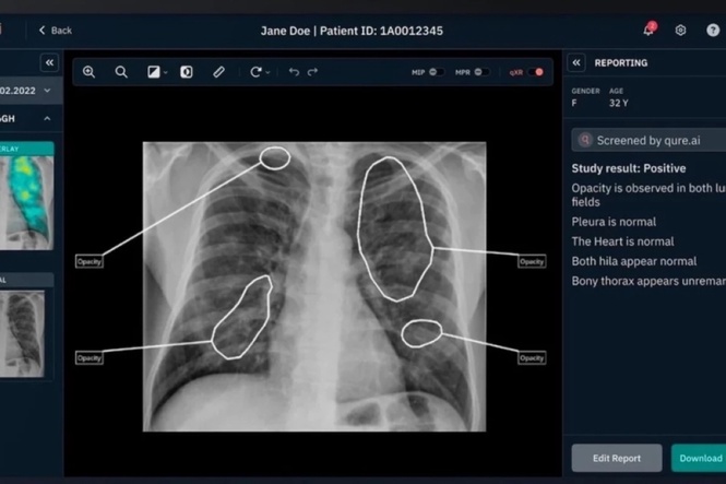 AI-assisted x-ray may lower TB detection costs in rural areas