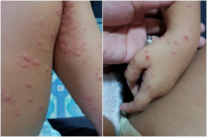 MOH weighs HFMD vaccine strategy as cases plunge 83%