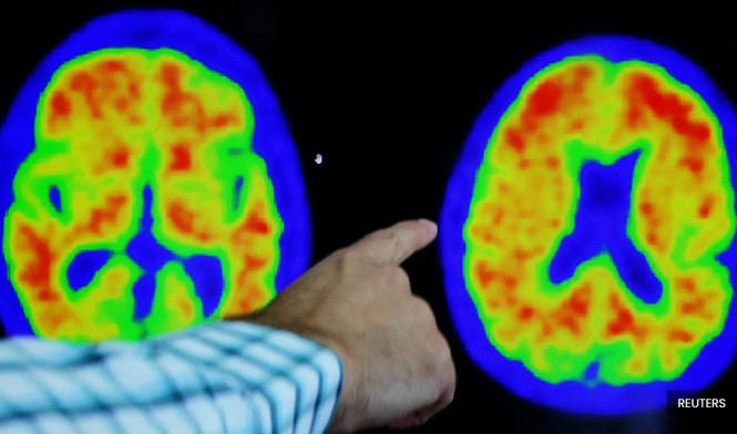 Alzheimer’s is more than forgetfulness as families also face major changes