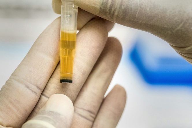 A New Urine Test Performs Better Than MRI and PSA for Low-Risk Prostate Cancer Monitoring