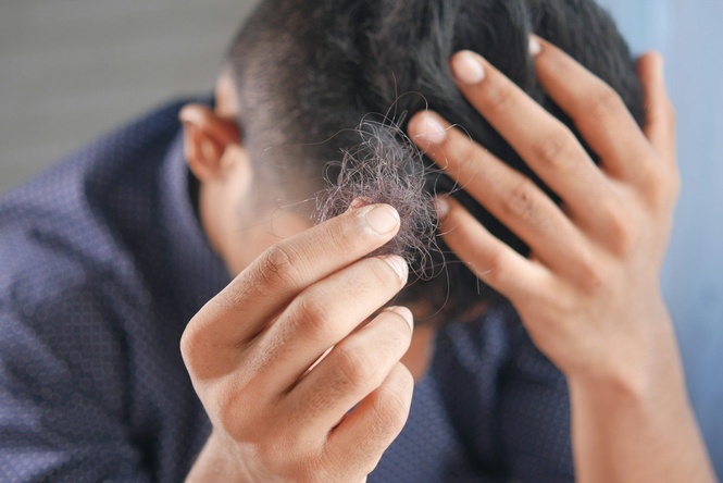 Rheumatoid Arthritis Drug Shows Strong Hair Regrowth Results in Severe Alopecia Trials
